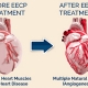 eecp treatment