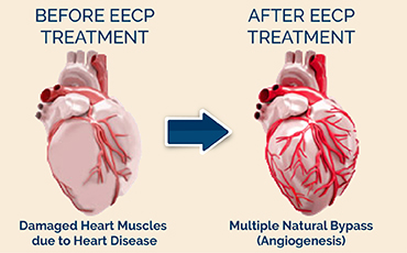 eecp treatment